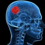 TRATAMIENTO TUMOR