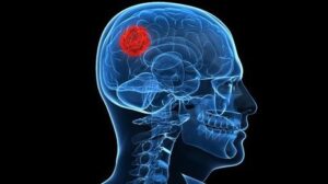 TRATAMIENTO TUMOR