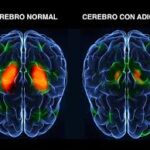 cerebro con adiccion y sin