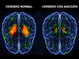 cerebro con adiccion y sin
